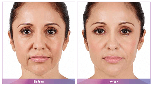 Juvederm before and after medical website design